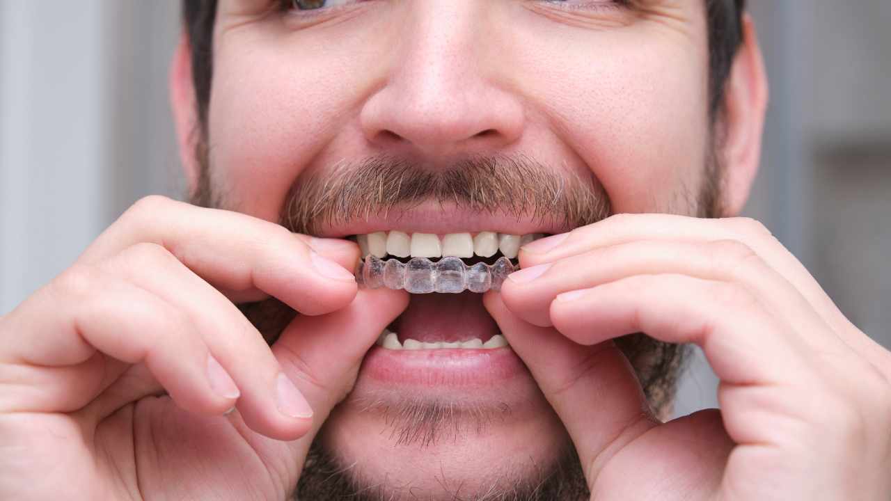 Achieving a Confident Smile with Braces: Understanding the Herbst Appliance